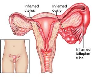 inflamed uterus and ovaries